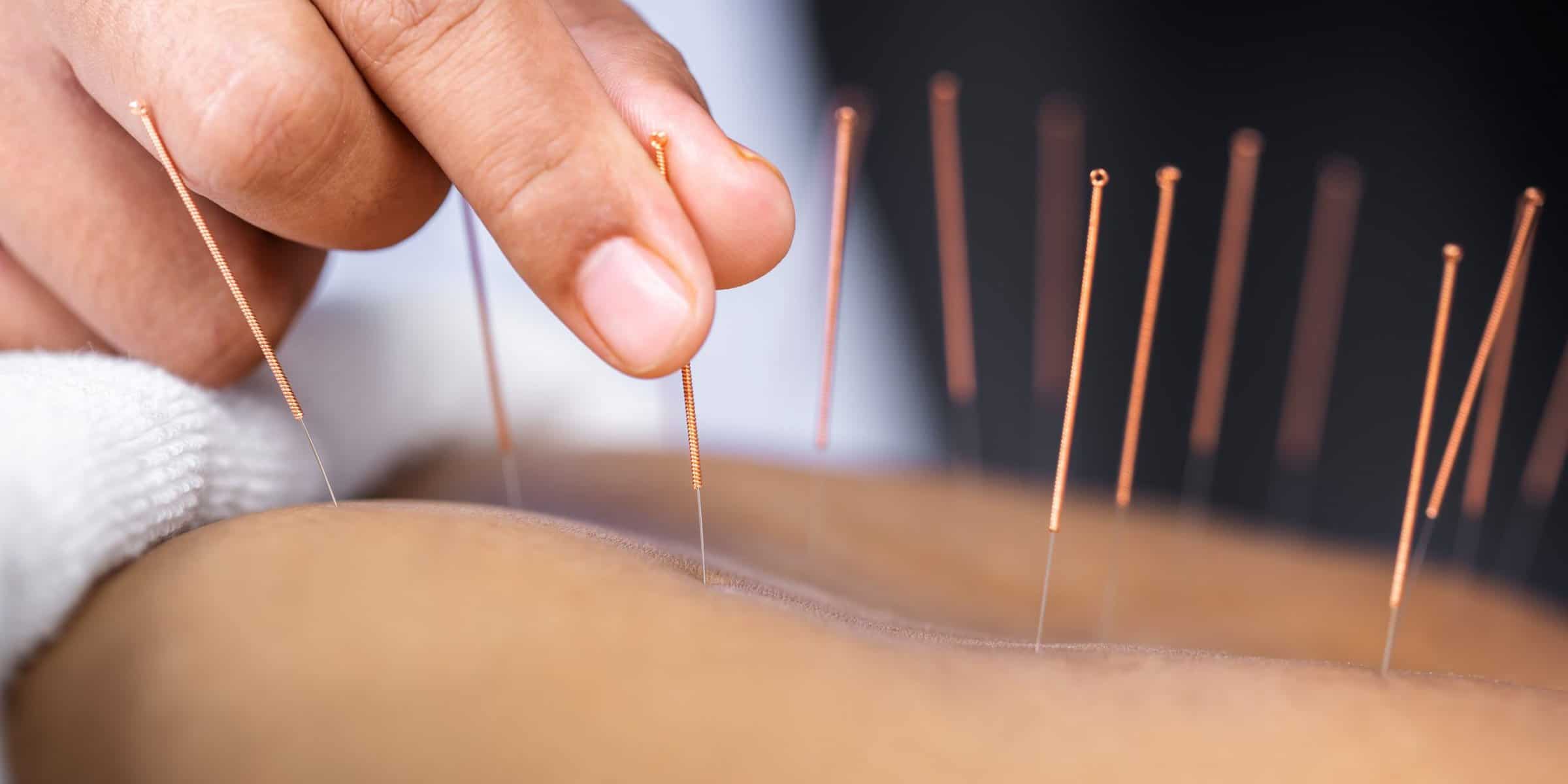 acupuncture in Hazlet, NJ