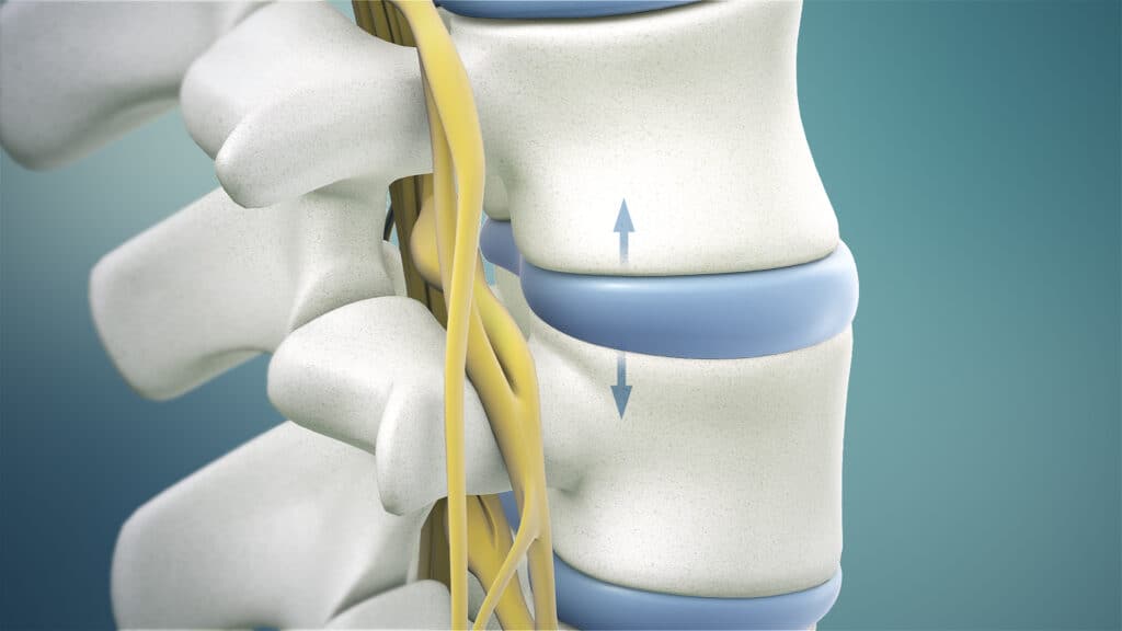 Spinal Decompression 2