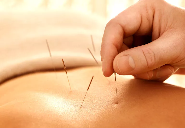 acupuncture in Hazlet, NJ